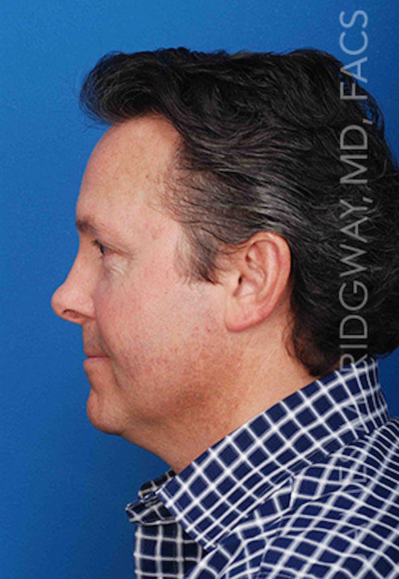 Nose Surgery (Rhinoplasty) Before & After Gallery - Patient 185108293 - Image 9