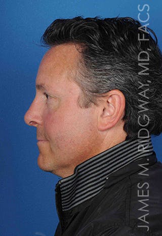 Nose Surgery (Rhinoplasty) Before & After Gallery - Patient 185108293 - Image 10