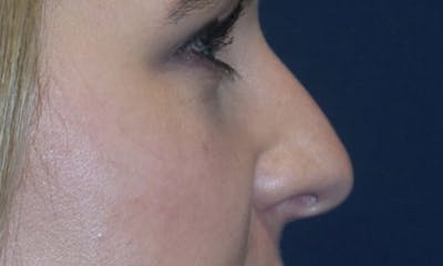 Rhinoplasty Before & After Gallery - Patient 180415262 - Image 1
