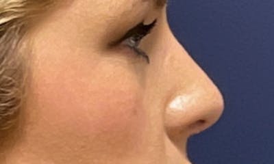 Rhinoplasty Before & After Gallery - Patient 180415262 - Image 2