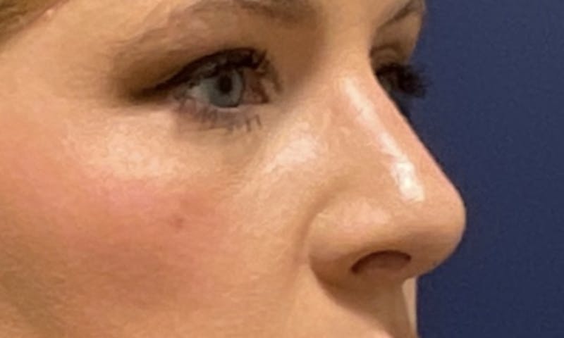 Rhinoplasty Before & After Gallery - Patient 180415262 - Image 4