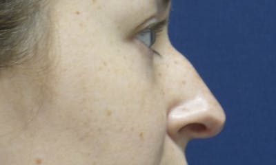 Rhinoplasty Before & After Gallery - Patient 179749765 - Image 1