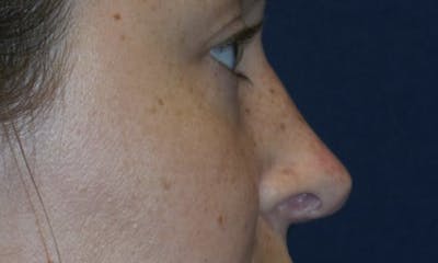 Rhinoplasty Before & After Gallery - Patient 179749765 - Image 2