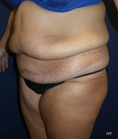 177 before