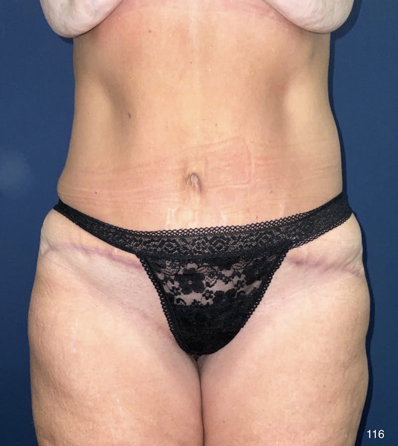 Mommy Makeover Before & After Gallery - Patient 180383389 - Image 8
