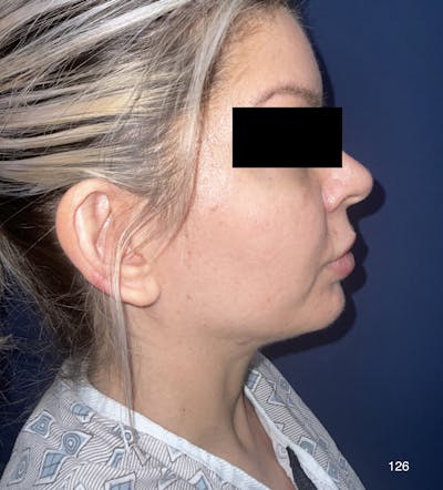Chin Augmentation Before & After Gallery - Patient 180403472 - Image 1