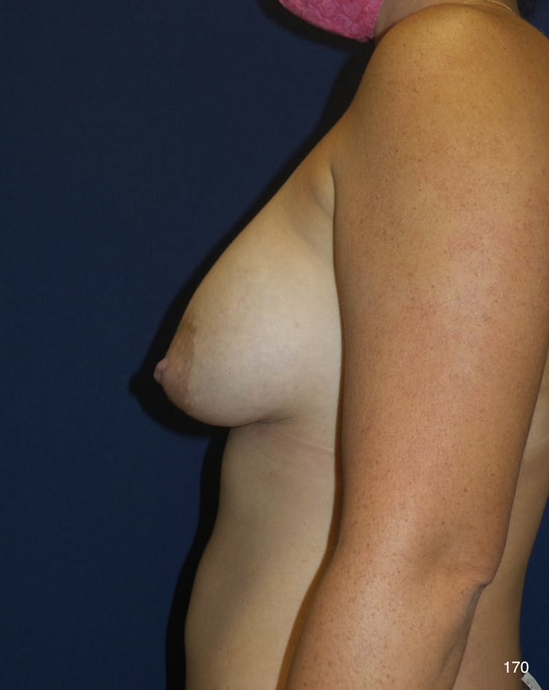 Capsulectomy Implant Exchange Before & After Gallery - Patient 180396706 - Image 1