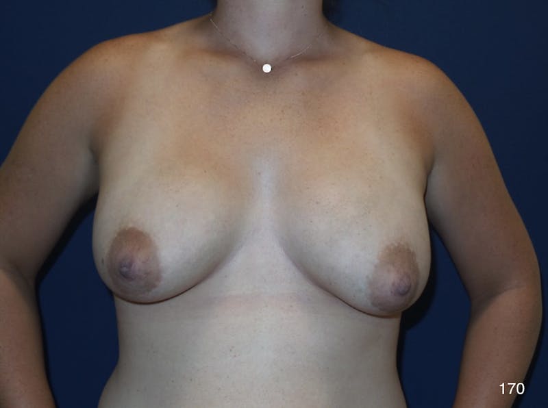 Capsulectomy Implant Exchange Before & After Gallery - Patient 180396706 - Image 2