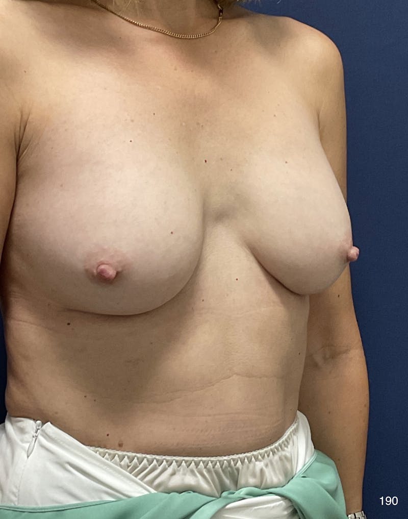Capsulectomy Implant Exchange Before & After Gallery - Patient 180396736 - Image 4