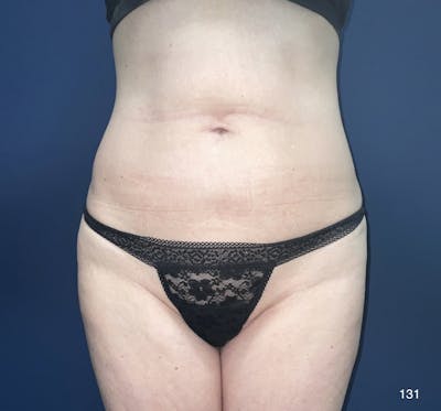 BodyTite/MorpheusBody Before & After Gallery - Patient 180396817 - Image 1