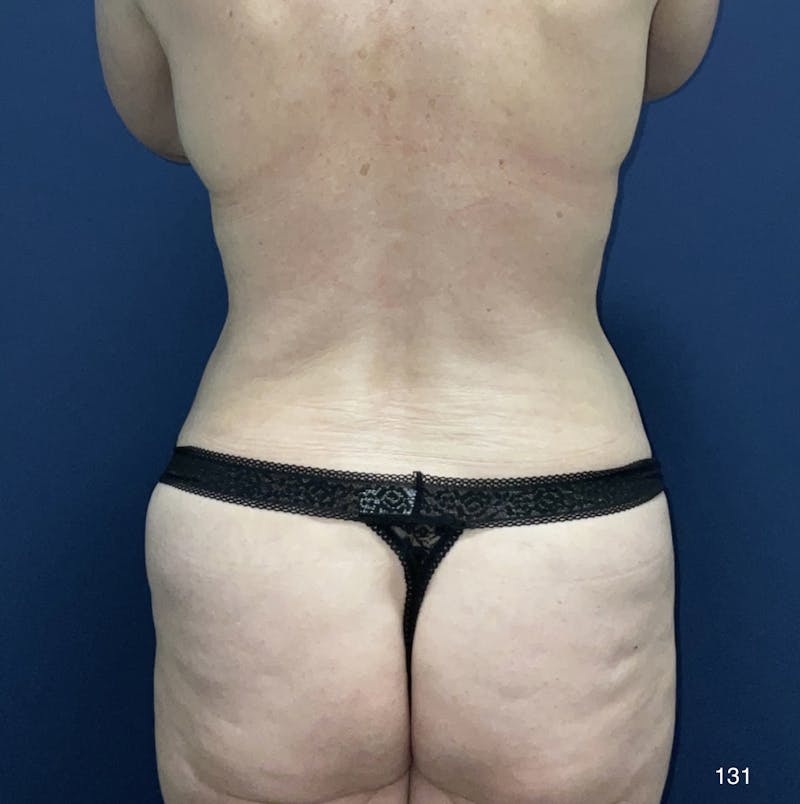 BodyTite/MorpheusBody Before & After Gallery - Patient 180396817 - Image 4