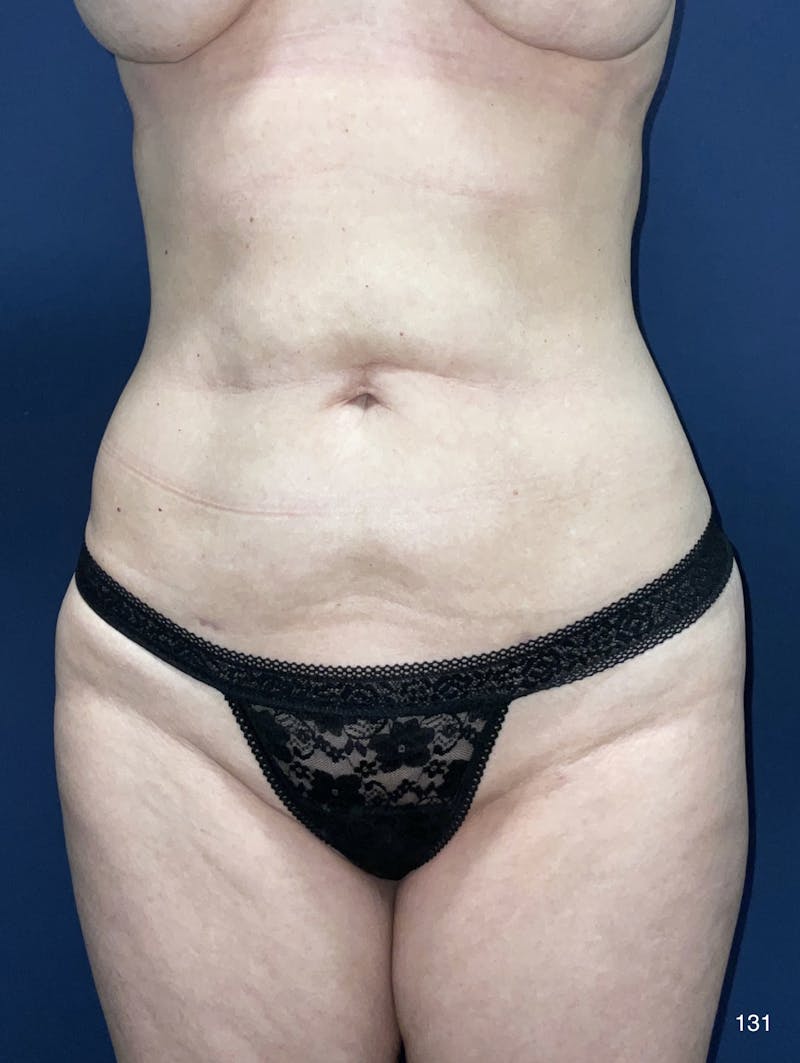 BodyTite/MorpheusBody Before & After Gallery - Patient 180396817 - Image 2