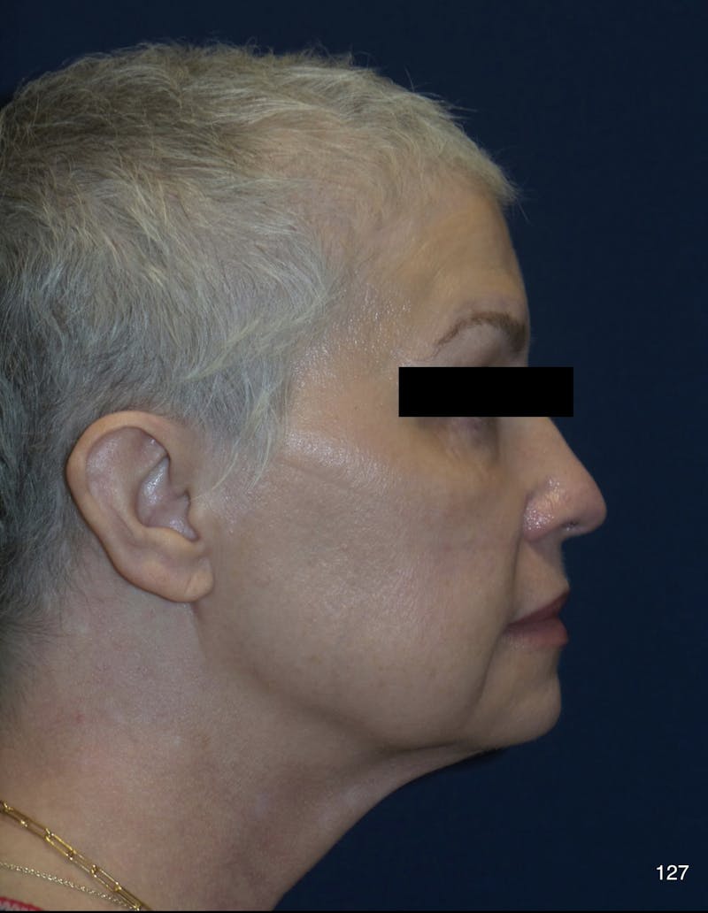 FaceTite/Morpheus8 Before & After Gallery - Patient 180396832 - Image 3