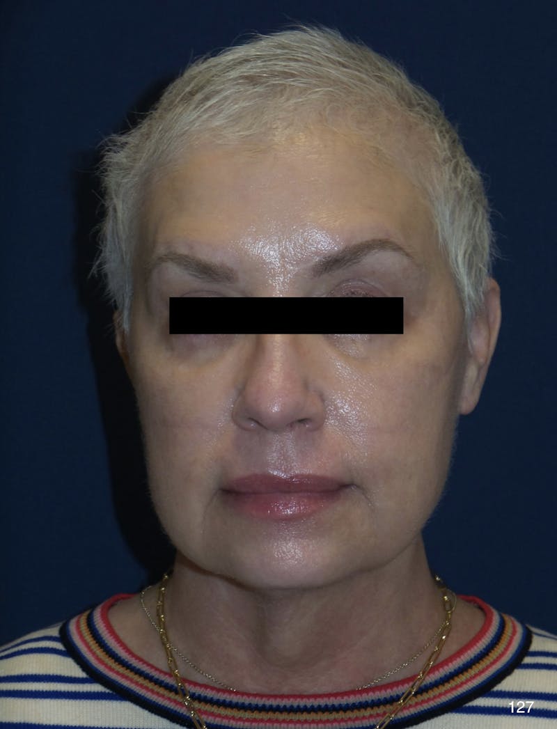 FaceTite/Morpheus8 Before & After Gallery - Patient 180396832 - Image 1