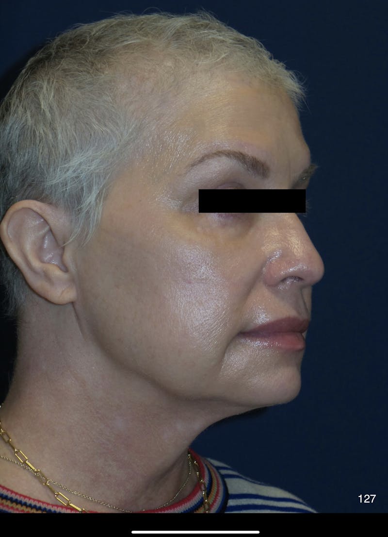FaceTite/Morpheus8 Before & After Gallery - Patient 180396832 - Image 5