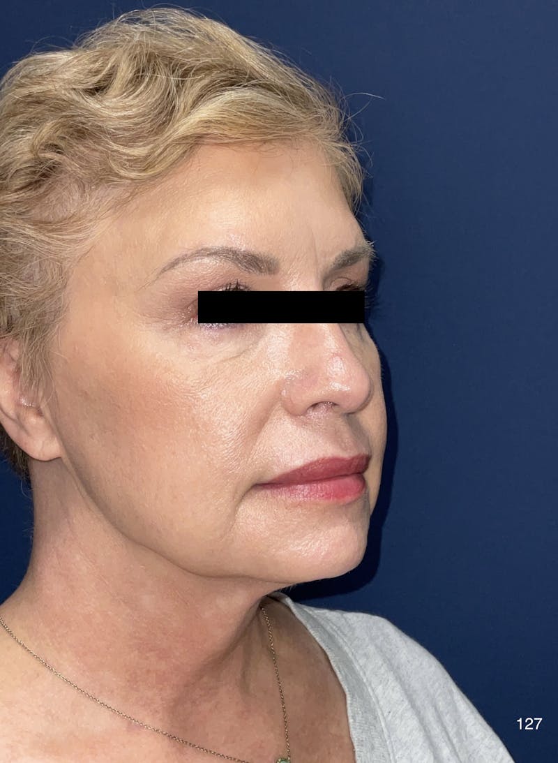 FaceTite/Morpheus8 Before & After Gallery - Patient 180396832 - Image 6