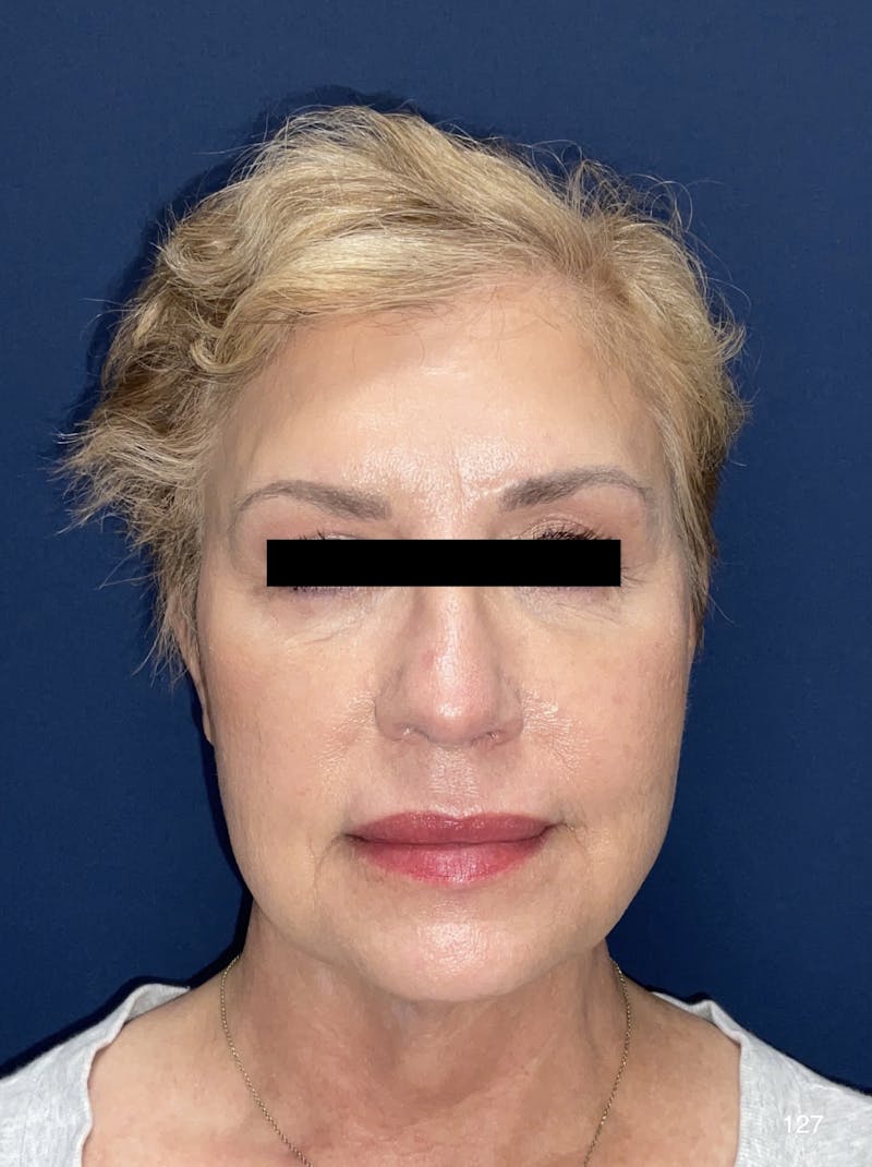 FaceTite/Morpheus8 Before & After Gallery - Patient 180396832 - Image 2