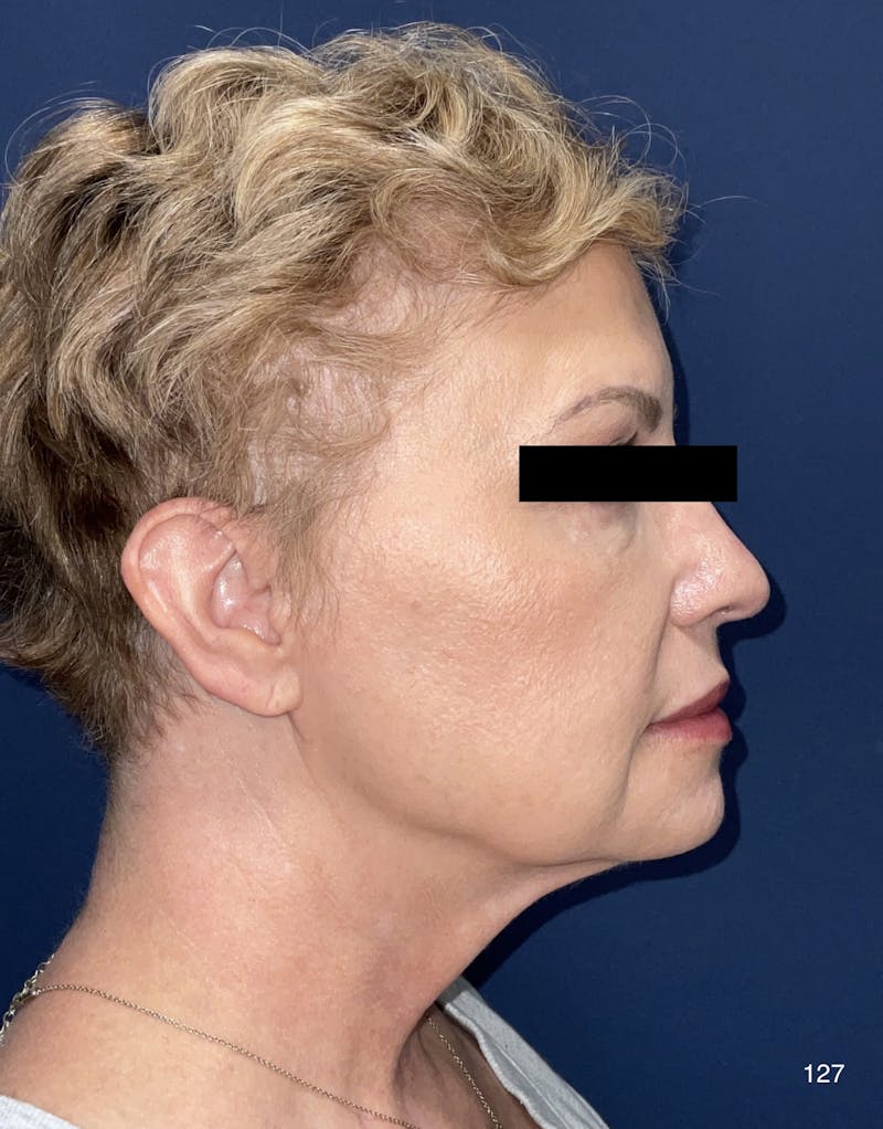FaceTite/Morpheus8 Before & After Gallery - Patient 180396832 - Image 4