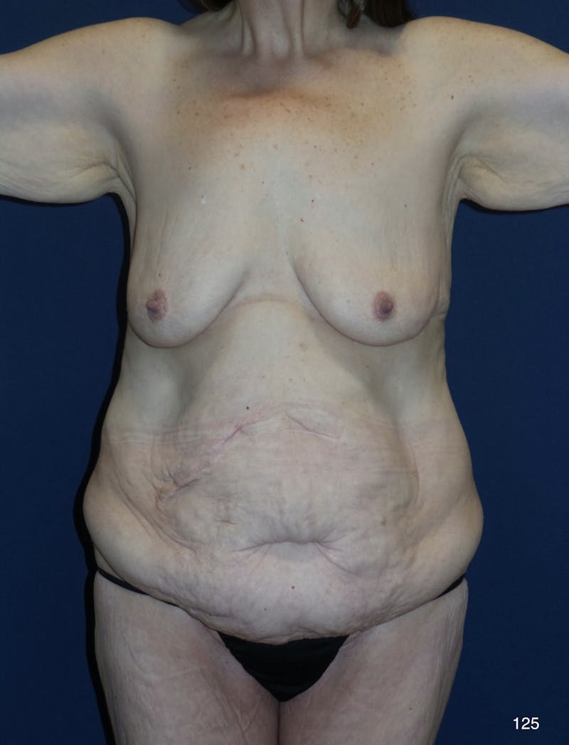 Tummy Tuck Before & After Gallery - Patient 180396846 - Image 1