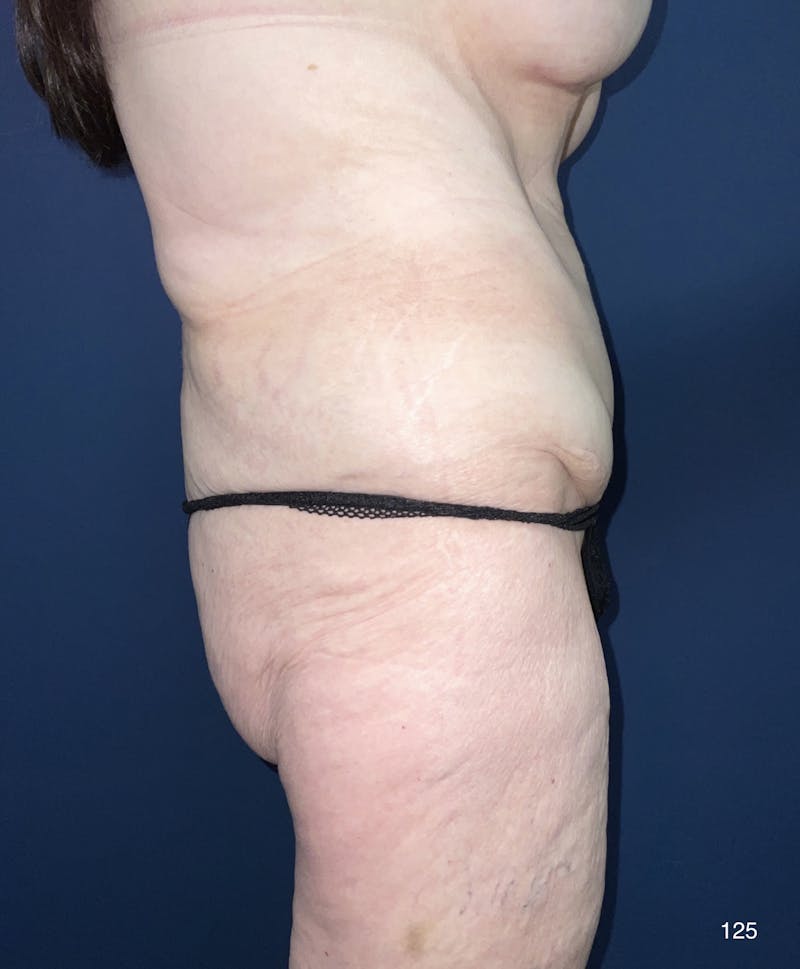 Tummy Tuck Before & After Gallery - Patient 180396846 - Image 4