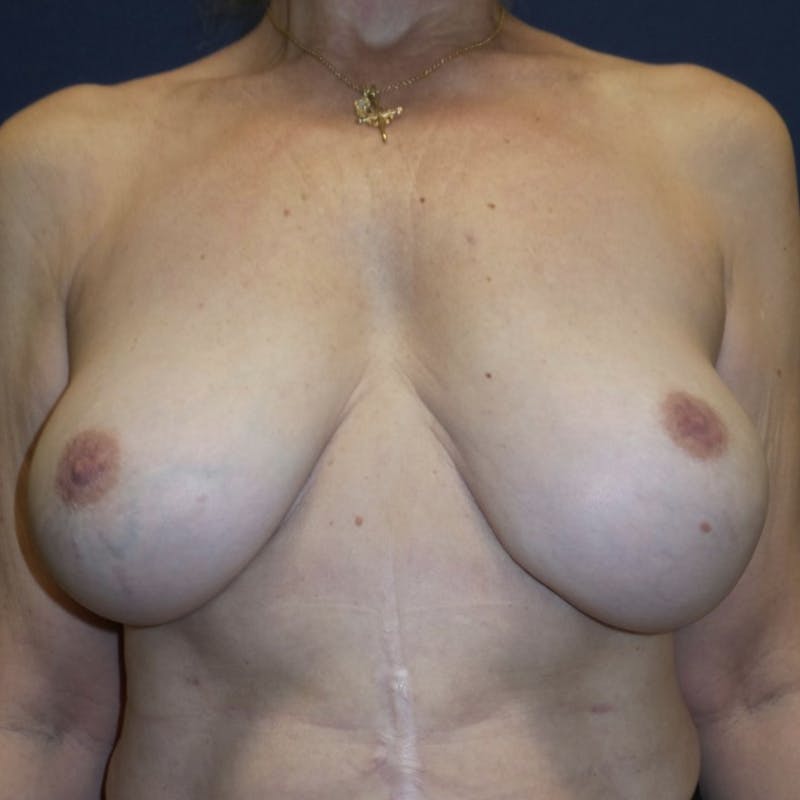 Breast Revision Before & After Gallery - Patient 180403464 - Image 4