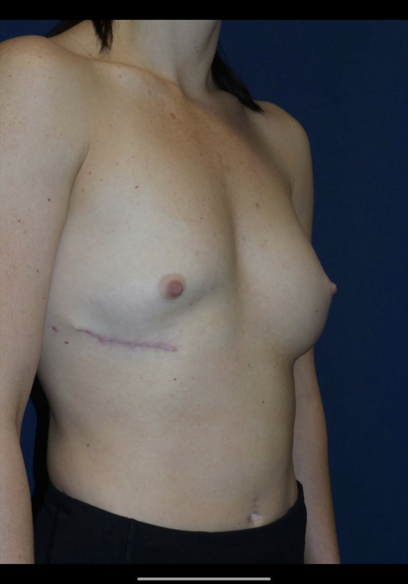 Breast Revision Before & After Gallery - Patient 180403465 - Image 1