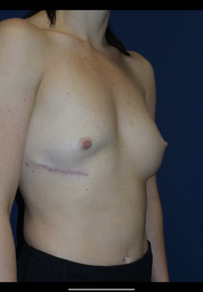 Breast Revision Before & After Gallery - Patient 180403465 - Image 1