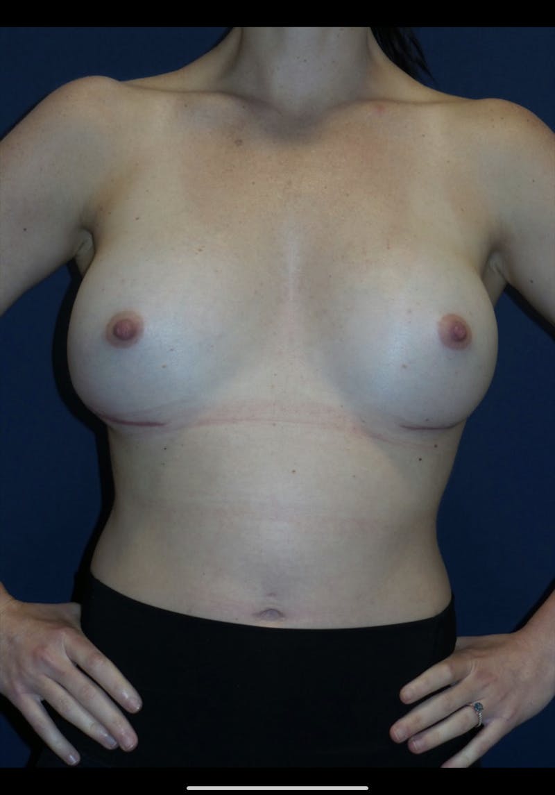 Breast Revision Before & After Gallery - Patient 180403465 - Image 4