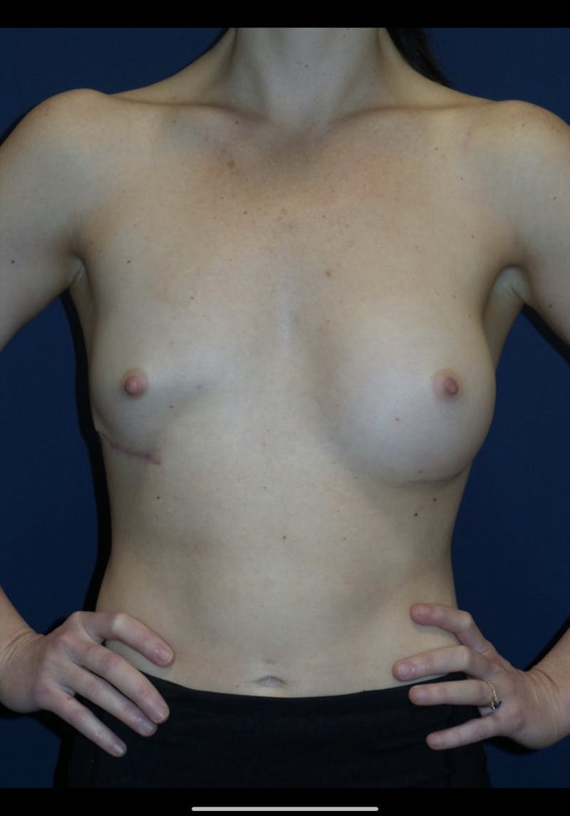 Breast Revision Before & After Gallery - Patient 180403465 - Image 3