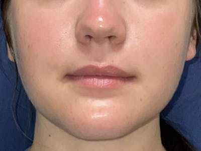 Buccal Fat Pad Removal Before & After Gallery - Patient 180403469 - Image 2