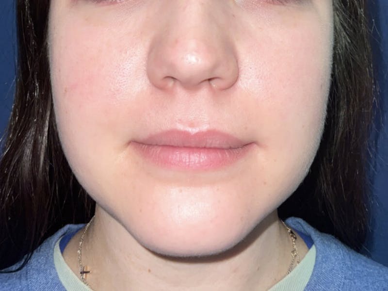 Buccal Fat Pad Removal Before & After Gallery - Patient 180403469 - Image 1