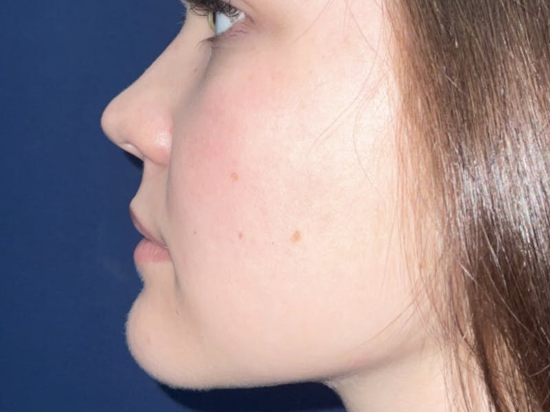 Buccal Fat Pad Removal Before & After Gallery - Patient 180403469 - Image 3