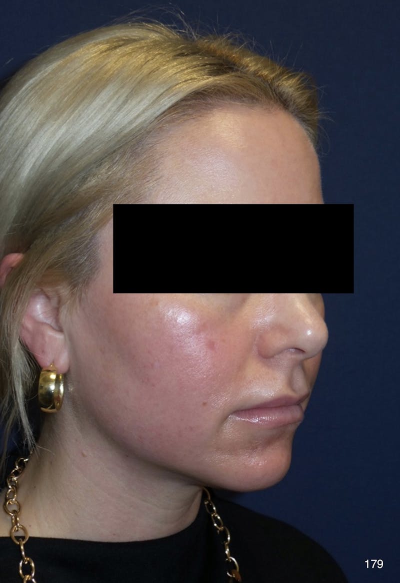 Chin Augmentation Before & After Gallery - Patient 179750044 - Image 1