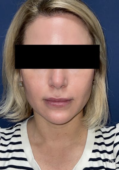 Buccal Fat Pad Removal Before & After Gallery - Patient 179749965 - Image 2