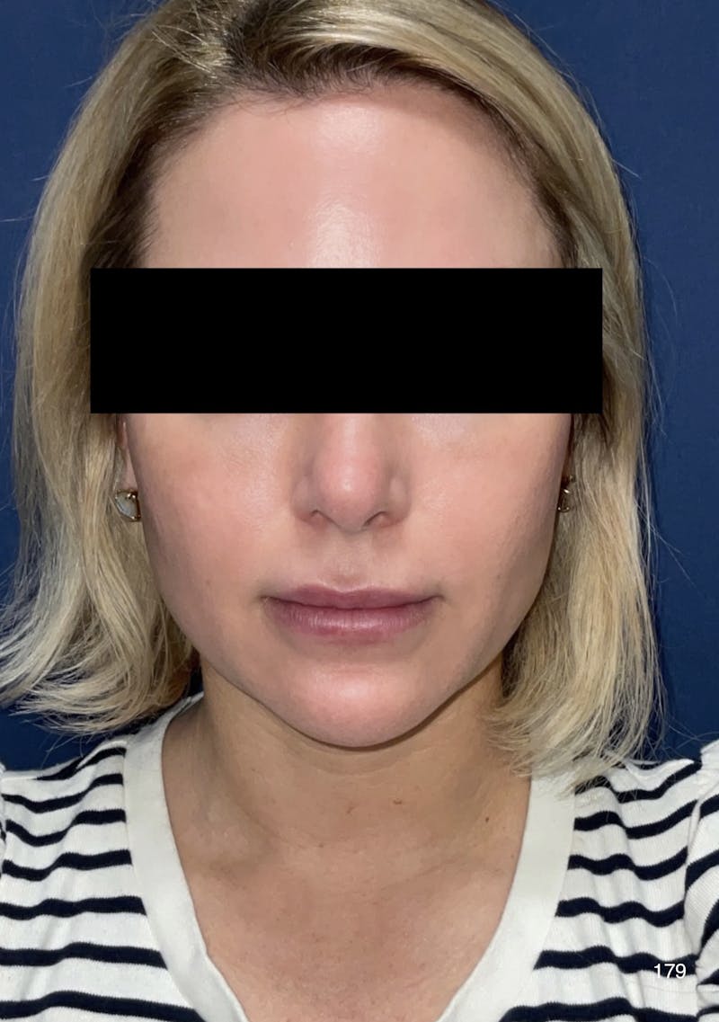 Chin Augmentation Before & After Gallery - Patient 179750044 - Image 6