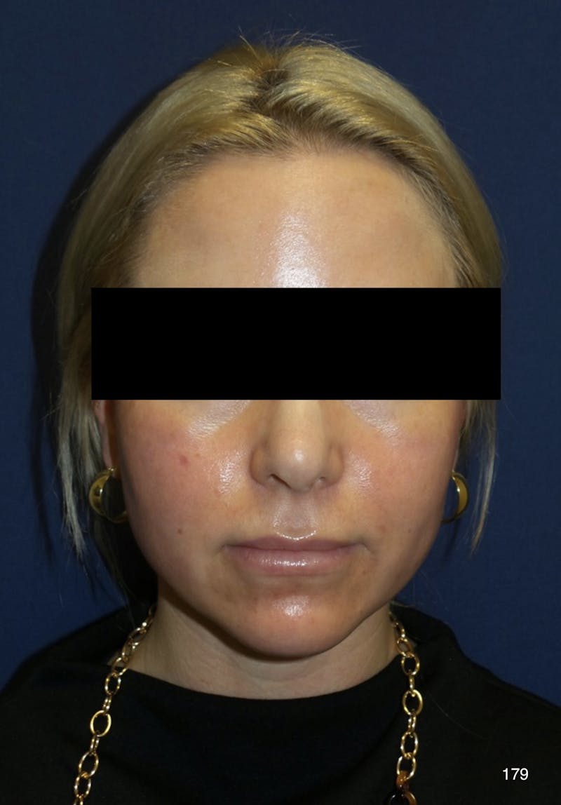 Buccal Fat Pad Removal Before & After Gallery - Patient 179749965 - Image 3