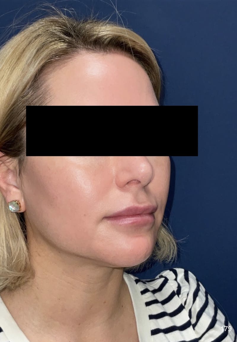 Buccal Fat Pad Removal Before & After Gallery - Patient 179749965 - Image 4