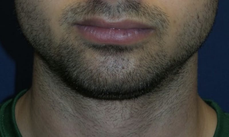 Chin Augmentation Before & After Gallery - Patient 180403473 - Image 3