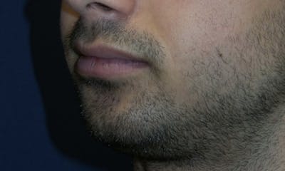 Chin Augmentation Before & After Gallery - Patient 180403473 - Image 1