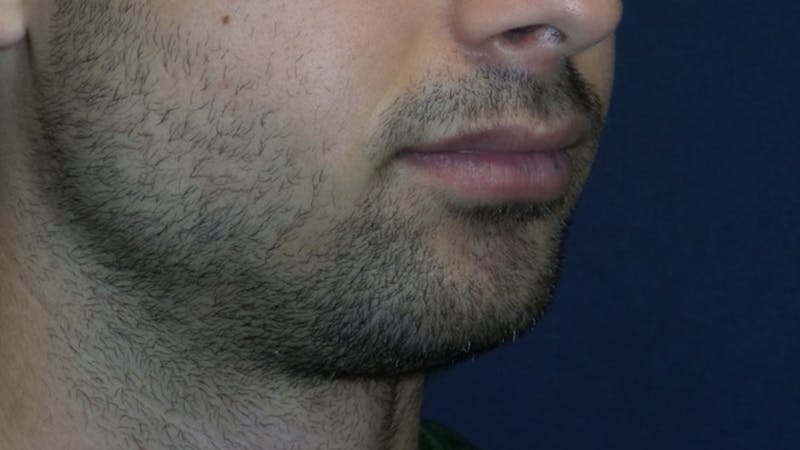 Chin Augmentation Before & After Gallery - Patient 180403473 - Image 5