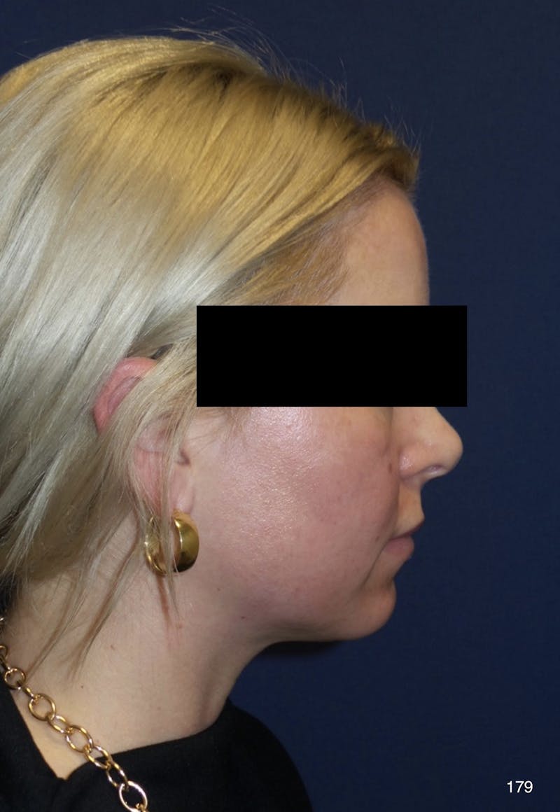 Chin Augmentation Before & After Gallery - Patient 179750044 - Image 3