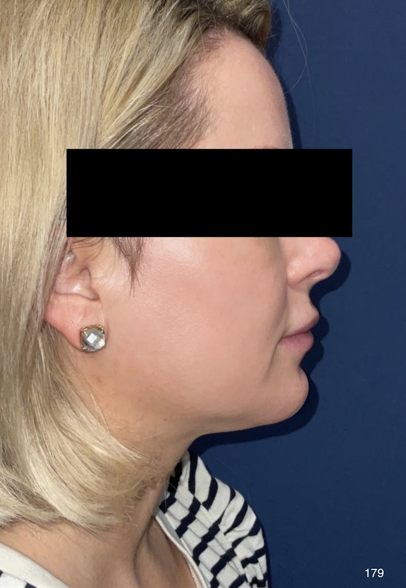Chin Augmentation Before & After Gallery - Patient 179750044 - Image 4