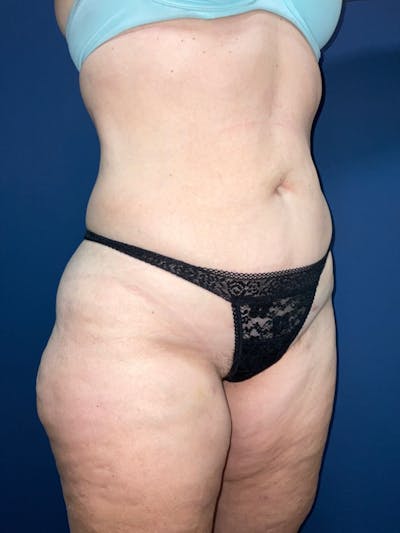 Liposuction Before & After Gallery - Patient 180403491 - Image 2