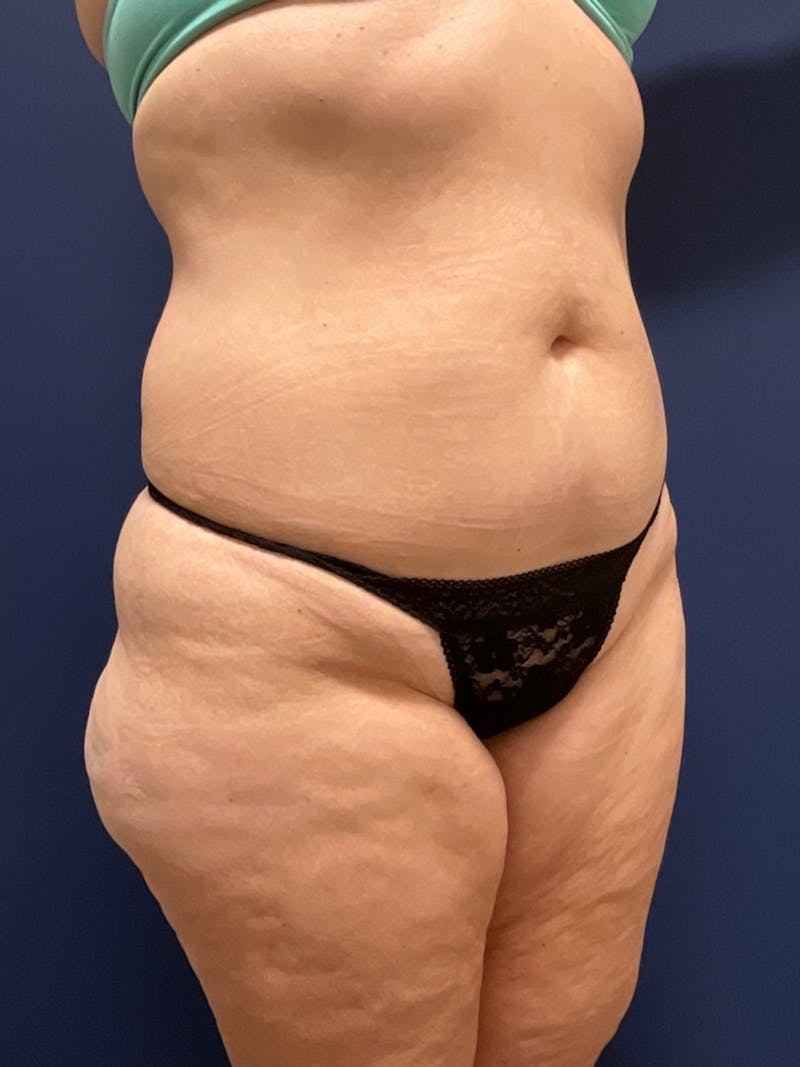 Liposuction Before & After Gallery - Patient 180403491 - Image 1