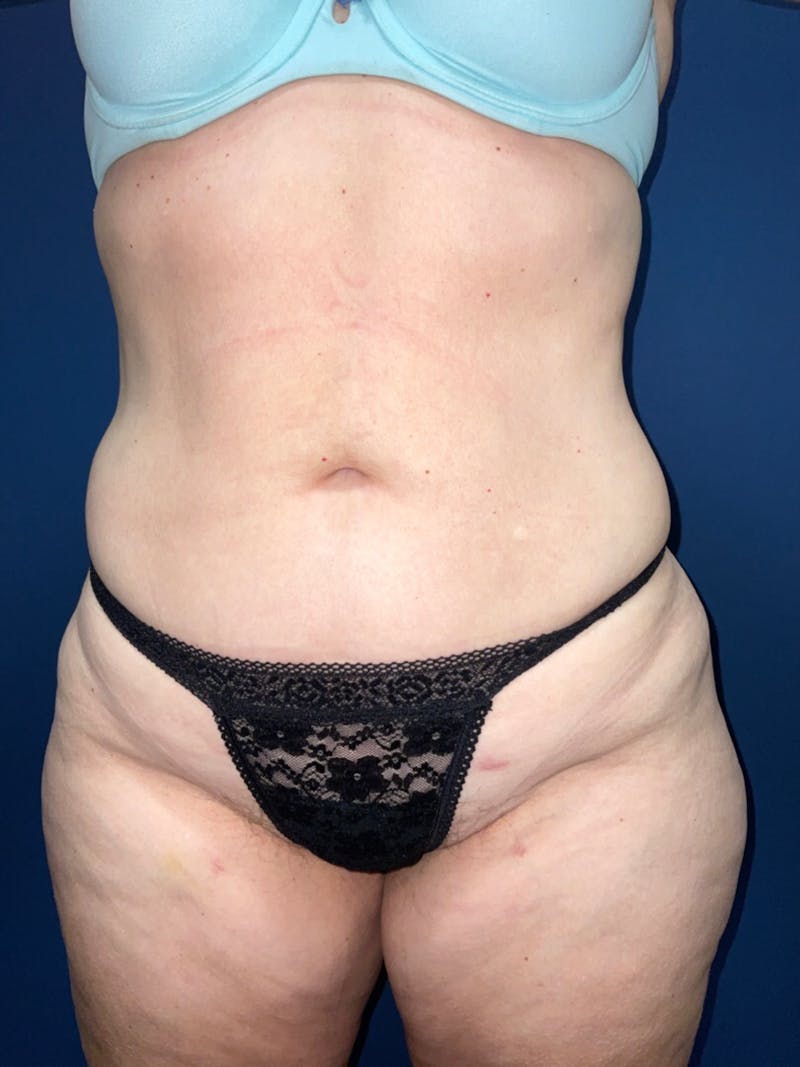 Liposuction Before & After Gallery - Patient 180403491 - Image 4