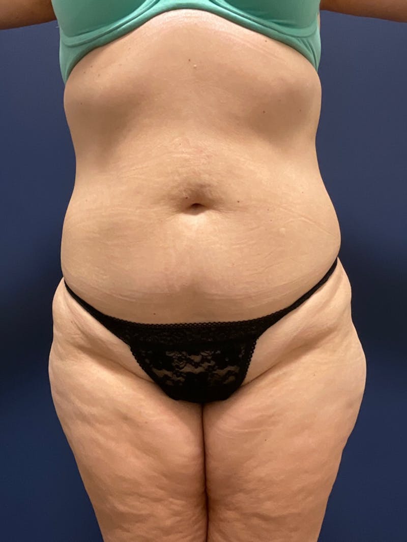 Liposuction Before & After Gallery - Patient 180403491 - Image 3