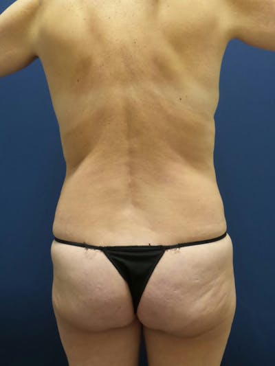 Liposuction Before & After Gallery - Patient 179749812 - Image 1