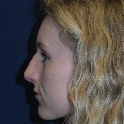 Rhinoplasty Before & After Gallery - Patient 180415263 - Image 2