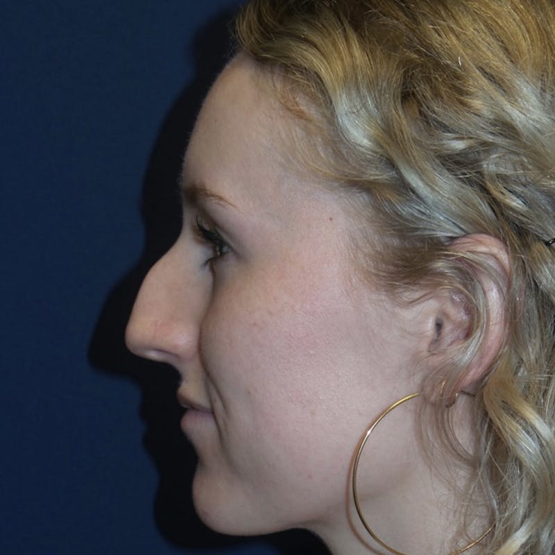 Rhinoplasty Before & After Gallery - Patient 180415263 - Image 1