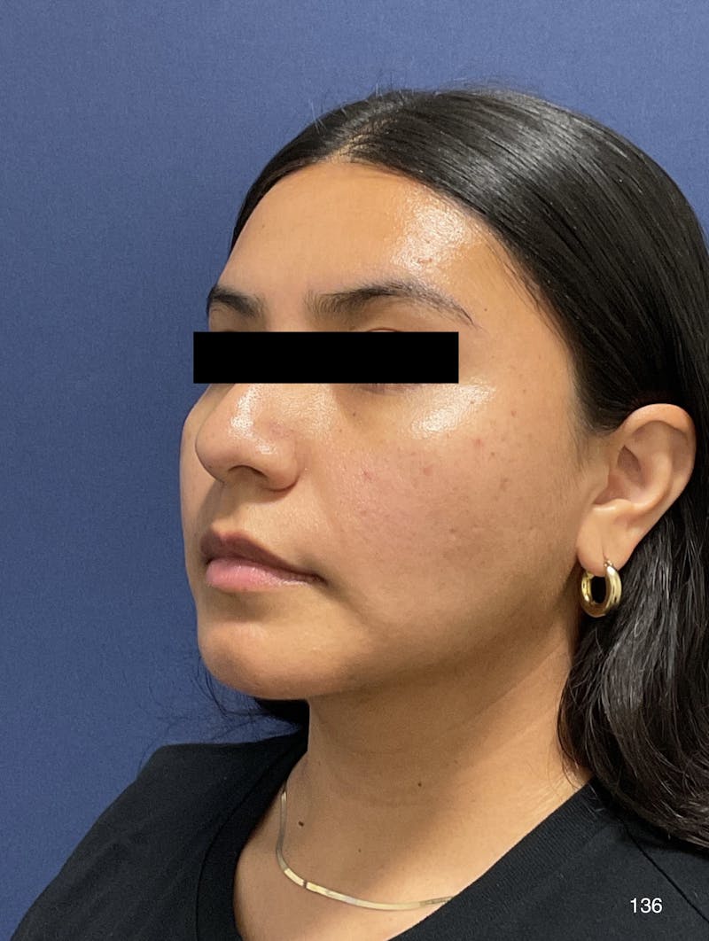 Buccal Fat Pad Removal Before & After Gallery - Patient 180396762 - Image 4